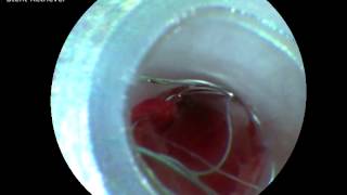 HighRes Angioscopic Imaging During Endovascular Neurosurgery Video 4 [upl. by Selene]