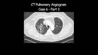 CT Pulmonary Angiogram  Case 6 Part 3 radiologist radiology angiogram pathological [upl. by Asik976]