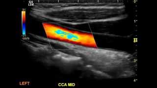 Normal Carotid Duplex [upl. by Skardol]