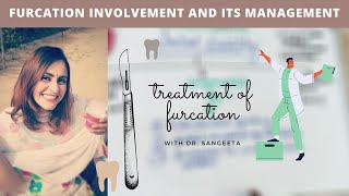 furcation involvement treatment easy explain [upl. by Ariaj]