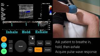 Ultrasound Tutorial DVT  Lower Limb Veins  Radiology Nation [upl. by Noryb]