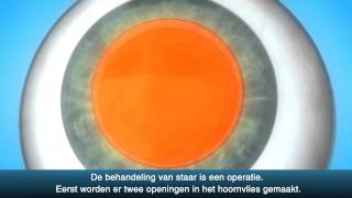 Staaroperatie cataract  OLVG Oogheelkunde [upl. by August]