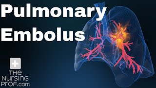 Pulmonary Embolus Nursing Care [upl. by Haldes]