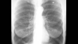 Emphysema on Chest X ray [upl. by Yeblehs]