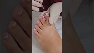 unhainfeccionada ingrowntoenail Unha extremamente inflamada [upl. by Justinn382]