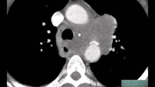 56yoM CXR CT Chest Adenopathy Discussed by Radiologistmp4 [upl. by Llenor]