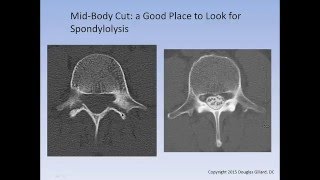 The Spondylolysis  Spondylolisthesis Lecture [upl. by Ahsemed954]