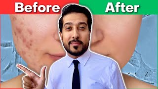 How to Get Rid of EVERY Type of Acne Scar  The Acne Scar ULTIMATE GUIDE [upl. by Eerok]