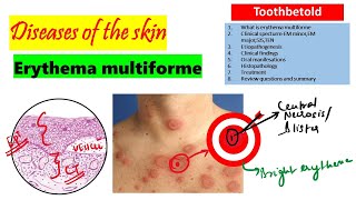 Erythema Multiforme  Etiology Clinical features Histopathology treatment [upl. by Eigger]