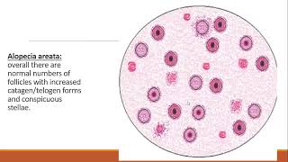 Lecture168 Alopecia Areata Trichotillomania Cosmetic Alopecia Rooks Chapter 89 [upl. by Llehsem20]