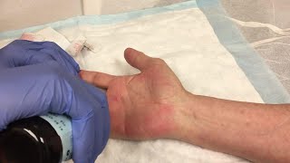 Steroid Injection for the Treatment of Trigger Finger [upl. by Araccot156]