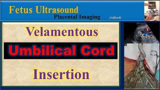 Fetus Ultrasound Velamentous Umbilical Cord Insertion [upl. by Ceil]