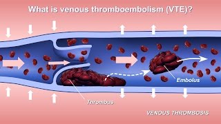 Understanding and Diagnosing Venous Thromboembolism VTE [upl. by Keven]