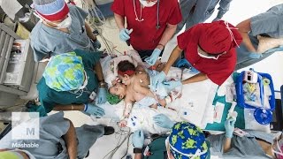 Conjoined twins survive 26hour separation surgery  Mashable [upl. by Aileduab]