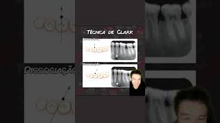 Descubra Como Funciona a Técnica de Clark  Resumo  Concurso Odontologia shorts [upl. by Llovera550]