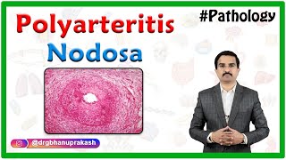 Polyarteritis nodosa  Definition Epidemiology Pathology Clinical features Diagnosis Treatment [upl. by Inihor701]