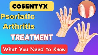 Cosentyx Psoriatic Arthritis Treatment  What You Need to Know [upl. by Nyrual]