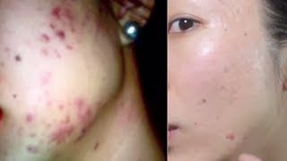 HOW TO GET RID OF ACNE SCARS BANISHCOM [upl. by Suhail]