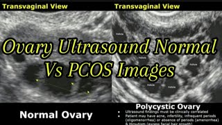 Ovary Ultrasound Normal Vs Polycystic Ovarian Syndrome PCOS Images  String Of Pearls Sign Ovaries [upl. by Jovita666]