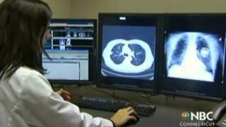 Using CT Scans to Screen for Lung Cancer [upl. by Occor557]