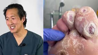 FOOT VIRAL PLANTAR WARTS REMOVING SATISFYING [upl. by Gyasi]