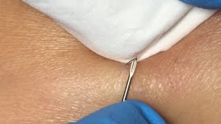 Ingrown Hairs Extraction  16 minutes [upl. by Aguste]