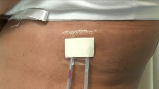 How to care for a postsurgery wound drainage system and Cutie dressing [upl. by Medrek]