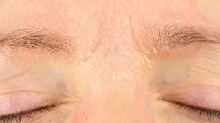 Why Do My Eyebrows Itch and Flake During the Winter [upl. by Heymann]