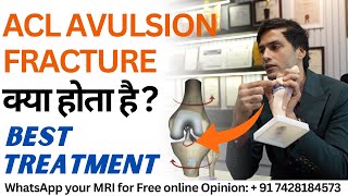 ACL Avulsion Fracture का बेस्ट इलाज  Best Treatment for ACL Avulsion Fracture [upl. by Moreta]