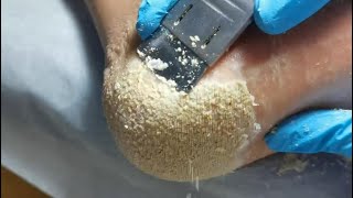 This is for lover of cheese Cracked heel treatment amp Callus removal Dead skin removal Foot care [upl. by Magnus]