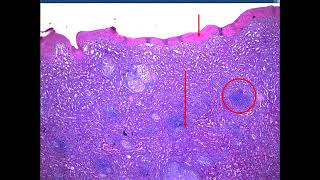 Sarcoidosis Rhino Actinomycosis Leprosy FB 2024  jars and slides [upl. by Ehrman]