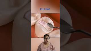 TOOTH FILLING  youtubeshorts dentalworld tiktok shortsfeed viral viralvideo video vlog [upl. by Alec]