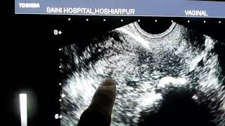 Myometrial Cysts [upl. by Nongim]