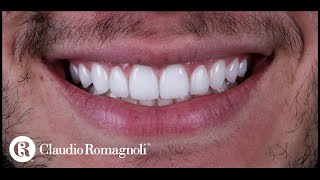 Casos Clínicos Design de Sorriso Para Dentes Conóides  Dr Claudio Romagnoli [upl. by Aliakim]