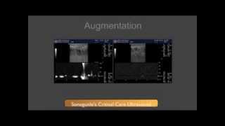 DVT Ultrasound Augmentation Technique [upl. by Meluhs145]