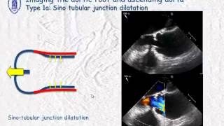 Imaging of aortic root and ascending aorta  what the surgeon has to know [upl. by Neoma284]