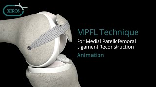 MPFL Technique using a 10 x 500 mm PolyTape Animation [upl. by Annabel]