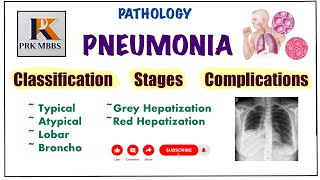 Pneumonia Pathology  Stages Of Pneumonia  Complications amp Lung Abscess pathology robbins [upl. by Ahseenak637]