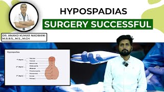 Hypospadias  मूत्र का छिद्र सही जगह पर न खुलने की समस्या  Hypospadias Repair in India  Dr Nagwani [upl. by Alvarez565]