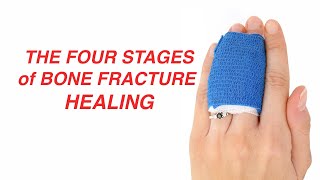 The Four Stages of Bone Fracture Healing [upl. by Haidabo]