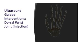 Ultrasound Guided Interventions Dorsal Wrist Joint Injection ultrasound [upl. by Areemas]