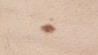 Melanoma symptoms How to spot signs and when to see a doctor [upl. by Hersh]