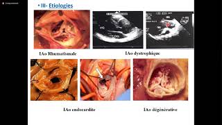 Insuffisance aortique [upl. by Kendricks823]