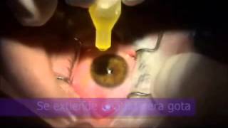 Técnica Crosslinking Corneal para pacientes con Queratocono realizada en Clínica Coro [upl. by Sharon]