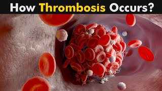 Thrombosis 3D Animation  Deep Vein Thrombosis  Symptoms  Causes and Treatment UrduHindi [upl. by Petulia397]