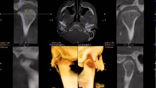 3D Scan of TMJ [upl. by Arlette]