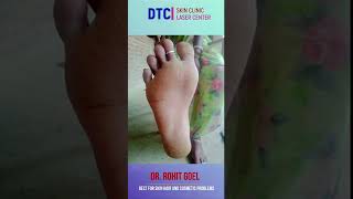 Porokeratosis  Dr Rohit Goel  DTCSKINCLINIC [upl. by Robenia848]