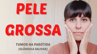 Pele grossa tumor na parótida [upl. by Jerad864]