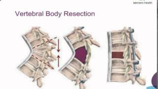 Arthropathy of the Spine by Dr Devinder Garewal [upl. by Delwyn]