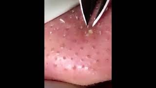 Skincare  Blackheads Removal 002 blackheads skincare [upl. by Charmain560]